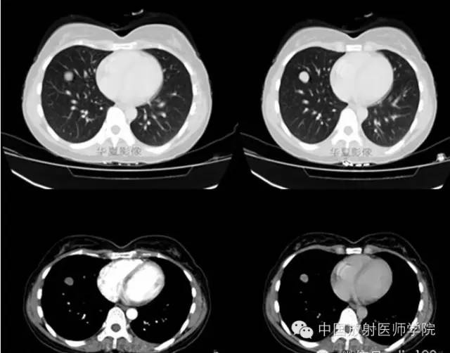 【病例】硬化性血管瘤一例CT影像表现