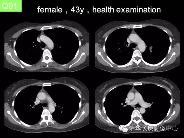 【病例】先天性支气管闭锁1例CT影像表现