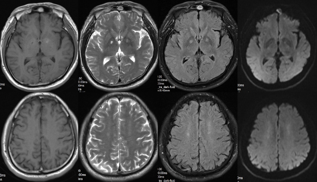 一氧化碳中毒性脑病1例MR影像