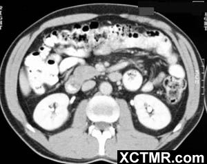 【病例】异位胰腺/迷走胰腺一例