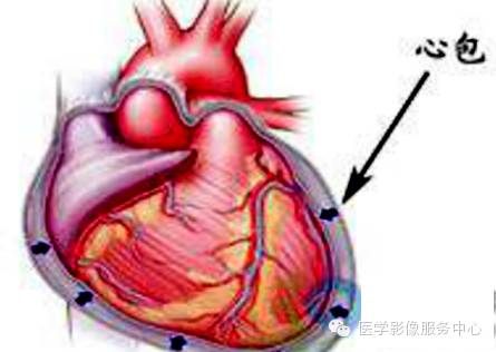 心包积液的影像学检查