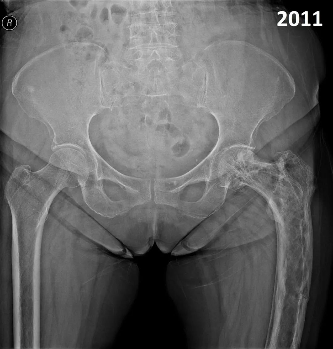 【病例】股骨Paget病伴病理性骨折1例X线