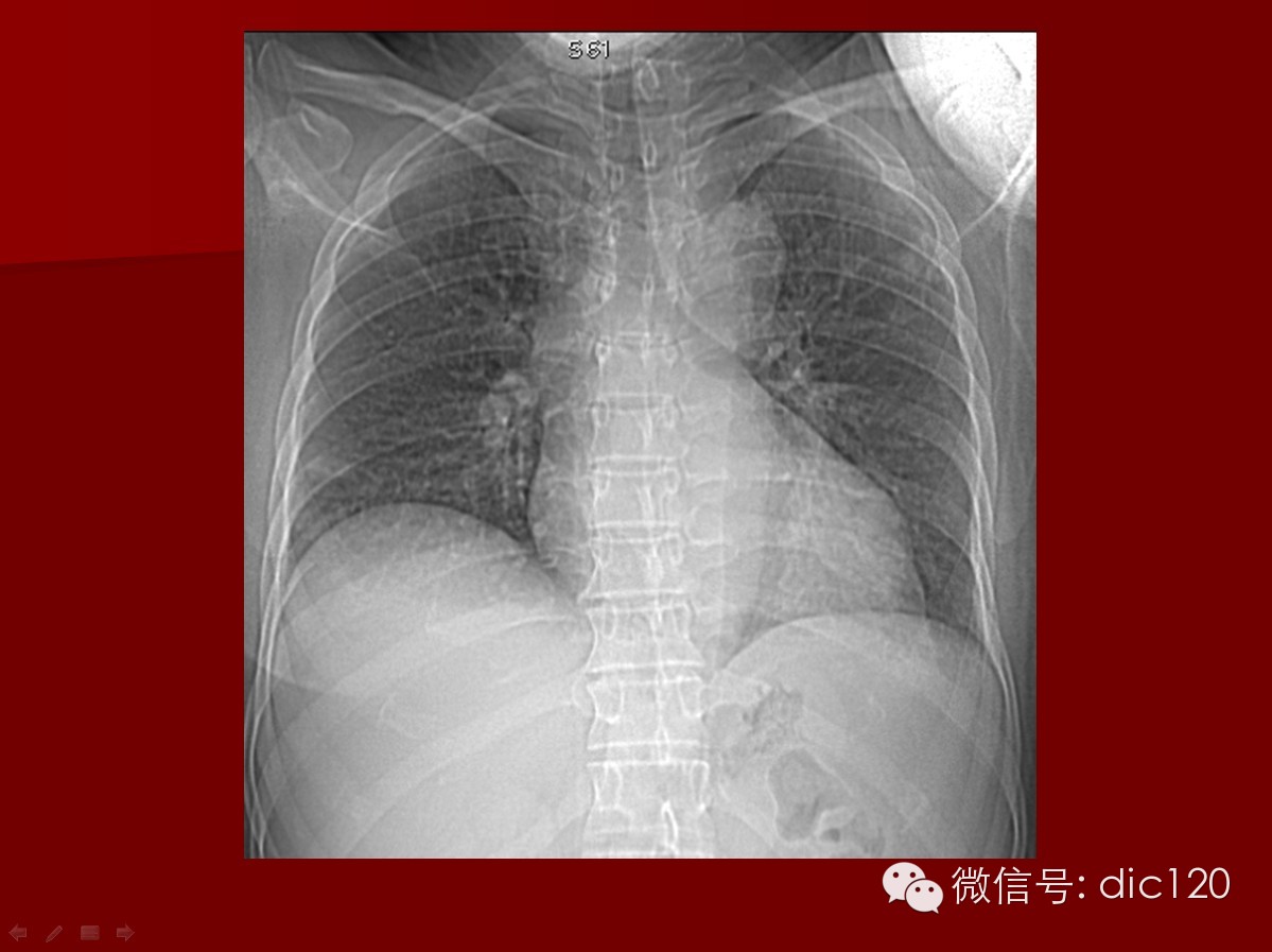 【少见病例】韦格纳肉芽肿一例CT诊断分析