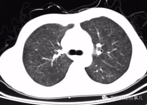 【少见病例】AIDS 合并马尔尼菲青霉菌病一例