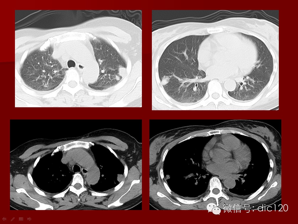 【少见病例】韦格纳肉芽肿一例CT诊断分析