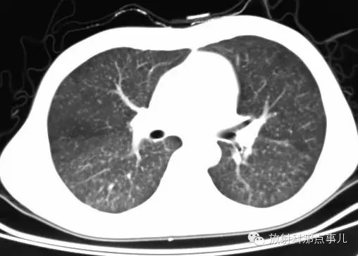 【少见病例】AIDS 合并马尔尼菲青霉菌病一例