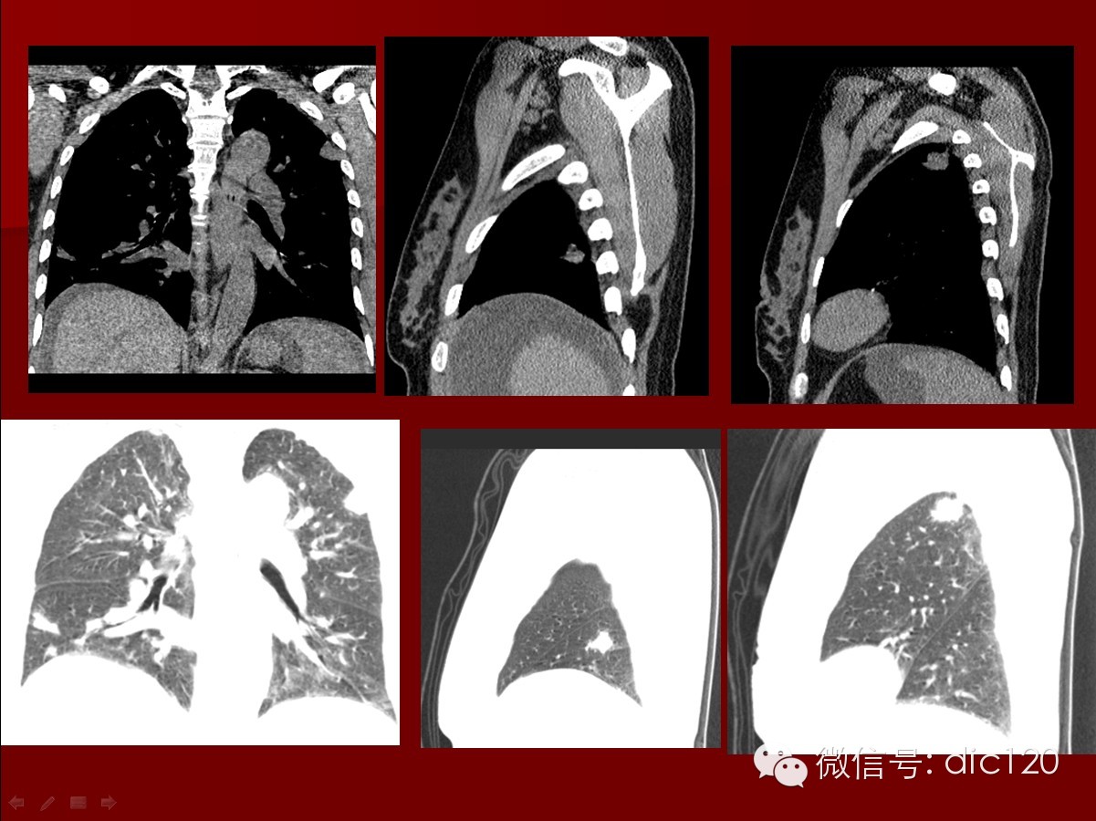 【少见病例】韦格纳肉芽肿一例CT诊断分析