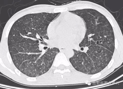【少见病例】AIDS 合并马尔尼菲青霉菌病一例