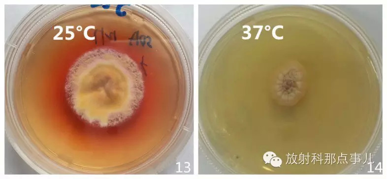 【少见病例】AIDS 合并马尔尼菲青霉菌病一例