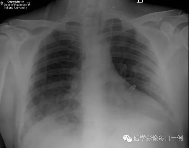 【病例】肺泡性出血1例X线 CT影像表现