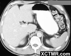 【病例】异位胰腺/迷走胰腺一例