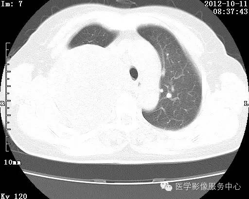 【病例】右肺巨大错构瘤1例CT影像表现