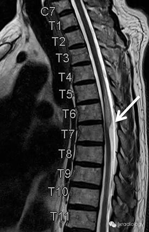 【病例】手术刀征—背侧蛛网膜网带1例MR影像