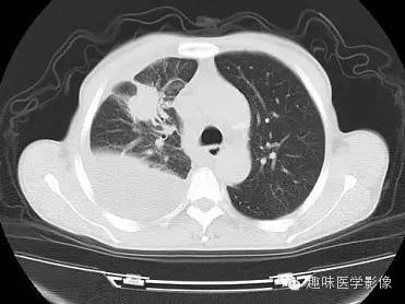 【病例】周围型肺癌1例CT影像特点