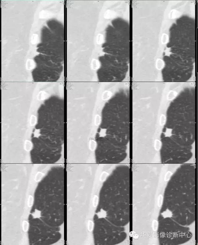 【病例学习】典型周围型肺癌CT病例一例