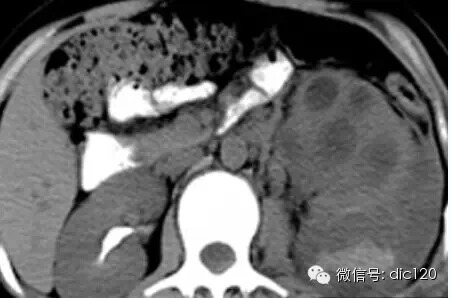 【病例】左肾黄色肉芽肿性肾盂肾炎CT诊断分析