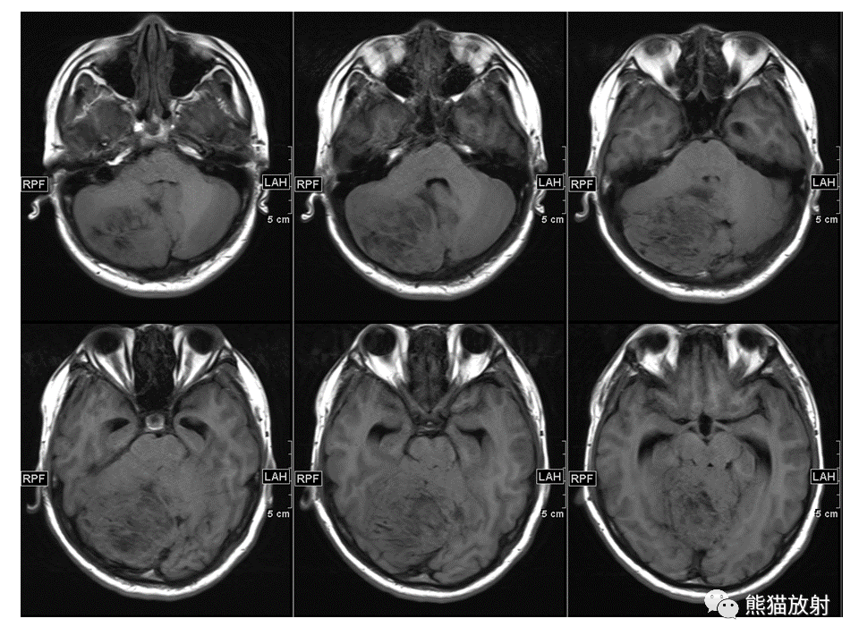 【PPT】小脑发育不良性神经节细胞瘤 VS 成人型髓母细胞瘤-3