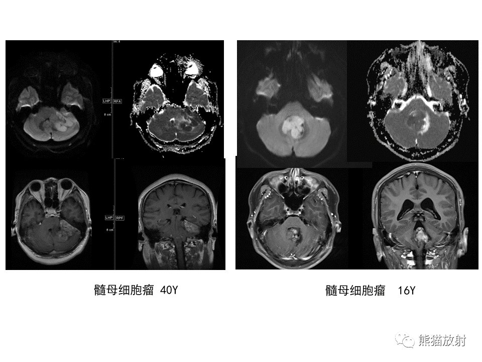 【PPT】小脑发育不良性神经节细胞瘤 VS 成人型髓母细胞瘤-37