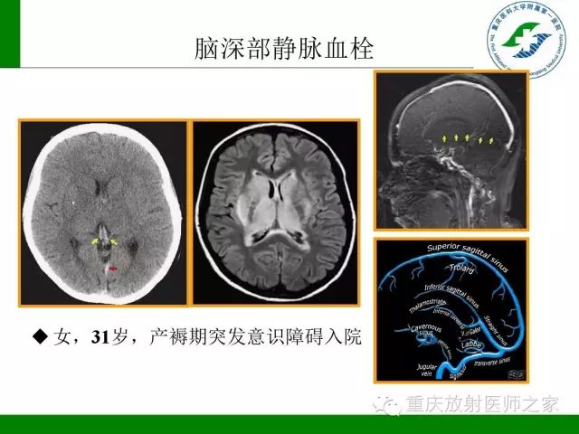 【PPT】脑静脉解剖及相关疾病影像学诊断-44