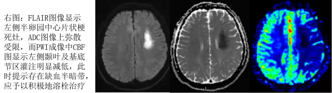 DWI、PWI在缺血性脑卒中上的应用以及联合应用对临床治疗方式选择的指导意义-17