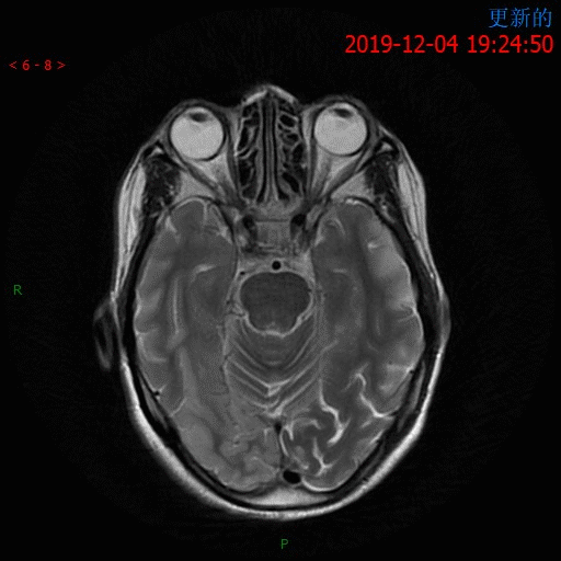 【病例】MELAS线粒体脑肌病伴高乳酸血症和卒中样发作综合征一例MR-6