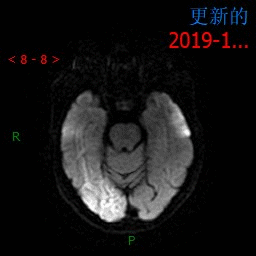 【病例】MELAS线粒体脑肌病伴高乳酸血症和卒中样发作综合征一例MR-7