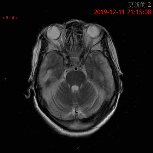 【病例】MELAS线粒体脑肌病伴高乳酸血症和卒中样发作综合征一例MR-8