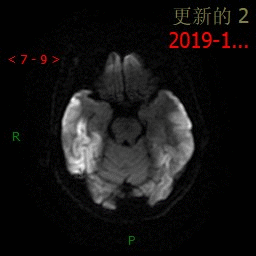 【病例】MELAS线粒体脑肌病伴高乳酸血症和卒中样发作综合征一例MR-9