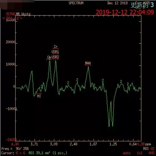 【病例】MELAS线粒体脑肌病伴高乳酸血症和卒中样发作综合征一例MR-10
