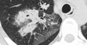 高密度病变肺HRCT基本解释