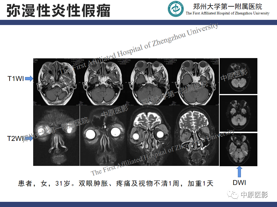 【病例】眼眶周围淋巴瘤1例CT及MR-22