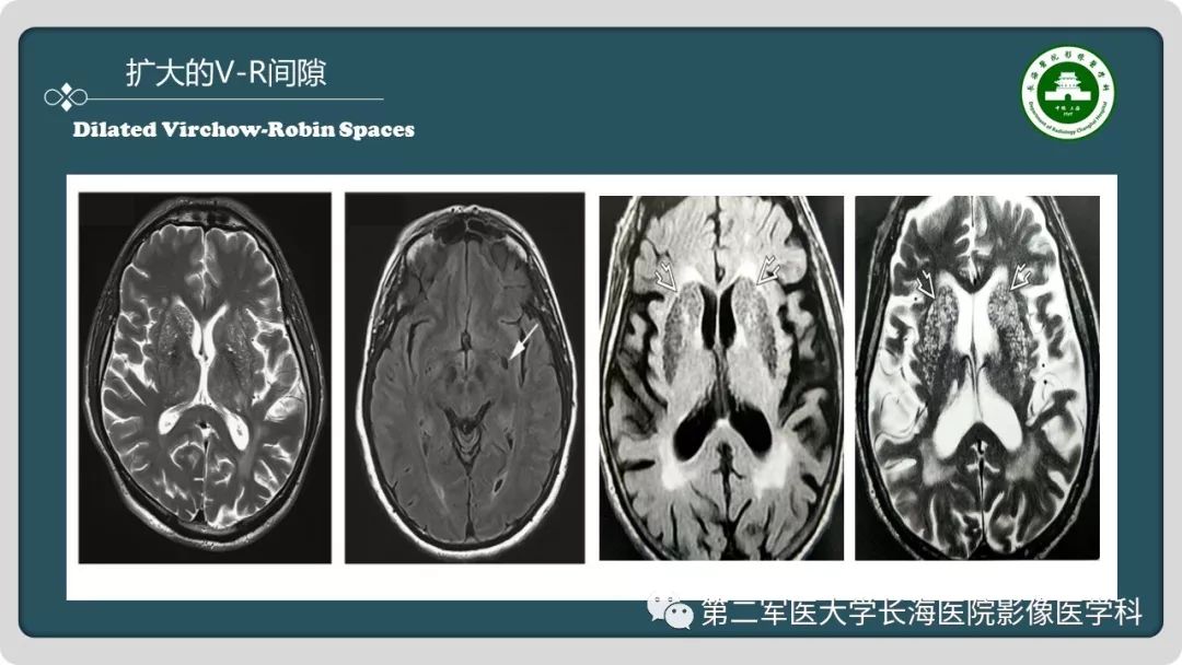 【PPT】颅内囊性病变影像表现-16