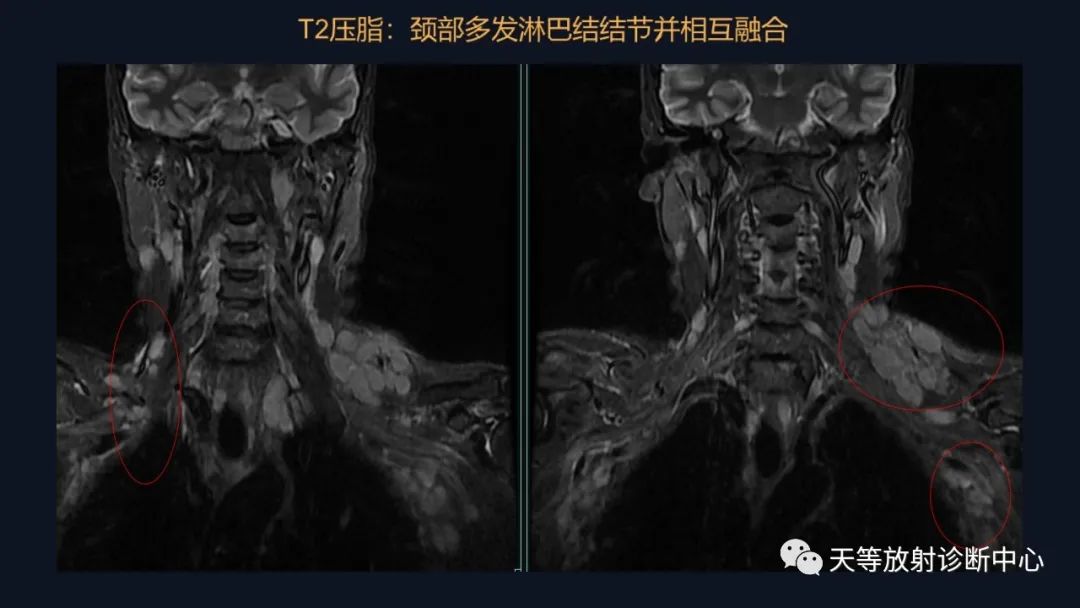【病例】脑内淋巴瘤1例MR影像分析-4