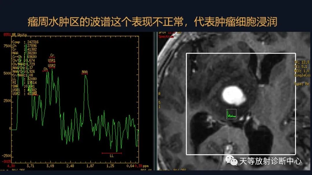 【病例】脑内淋巴瘤1例MR影像分析-39