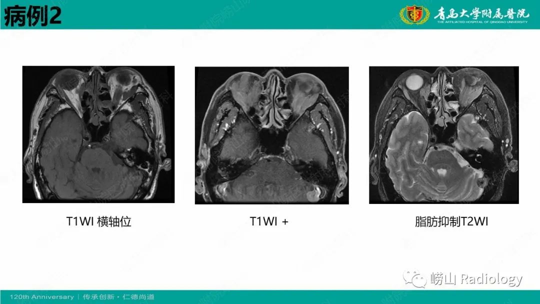 【病例】Rosai-Dorfman病 & 套细胞淋巴瘤-12