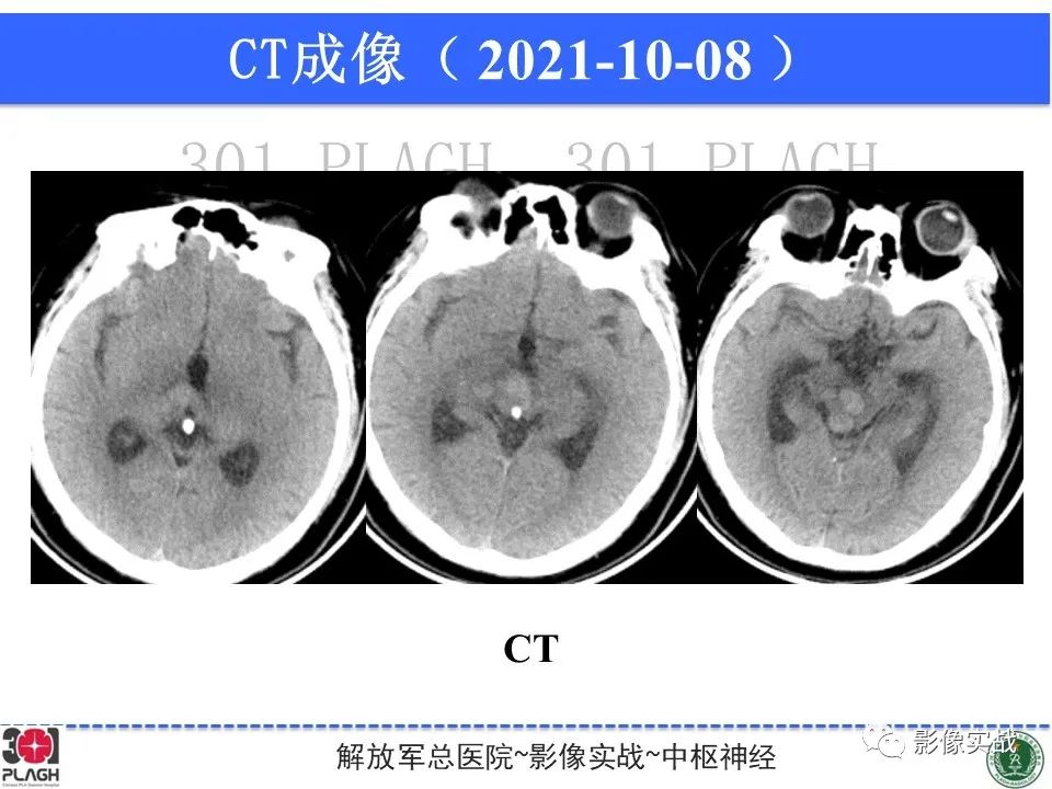 【病例】中枢神经系统生殖细胞肿瘤1例MR-26