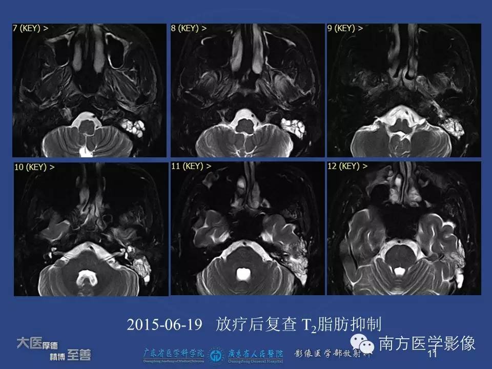 【PPT】鼻咽癌累及中耳及与中耳炎的鉴别-11