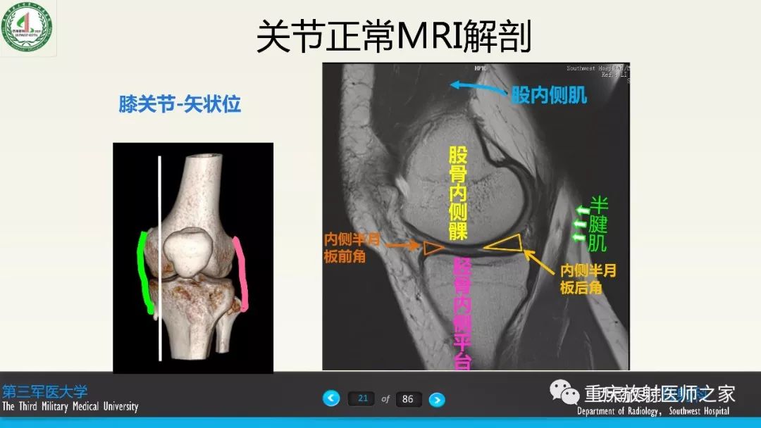 【PPT】膝关节韧带MRI诊断要点-21
