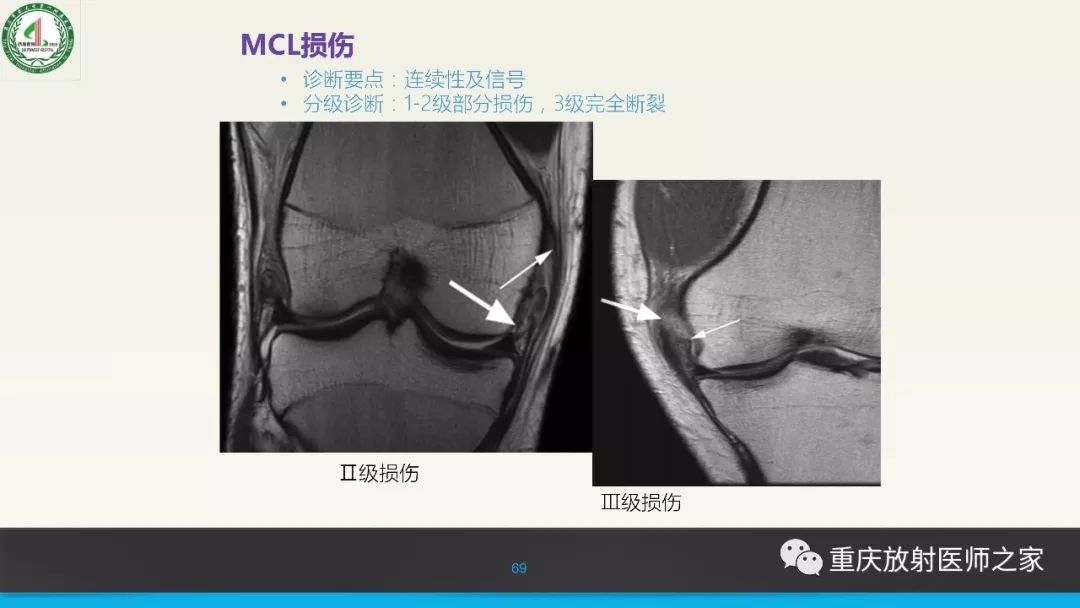 【PPT】膝关节韧带MRI诊断要点-69