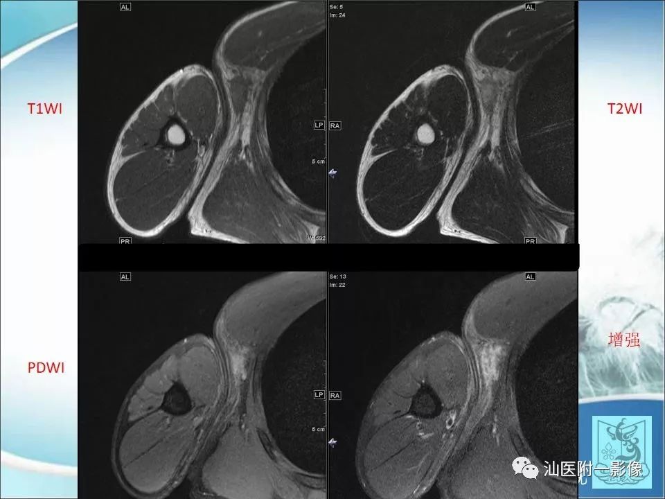 【病例】猫抓病1例MR影像-2