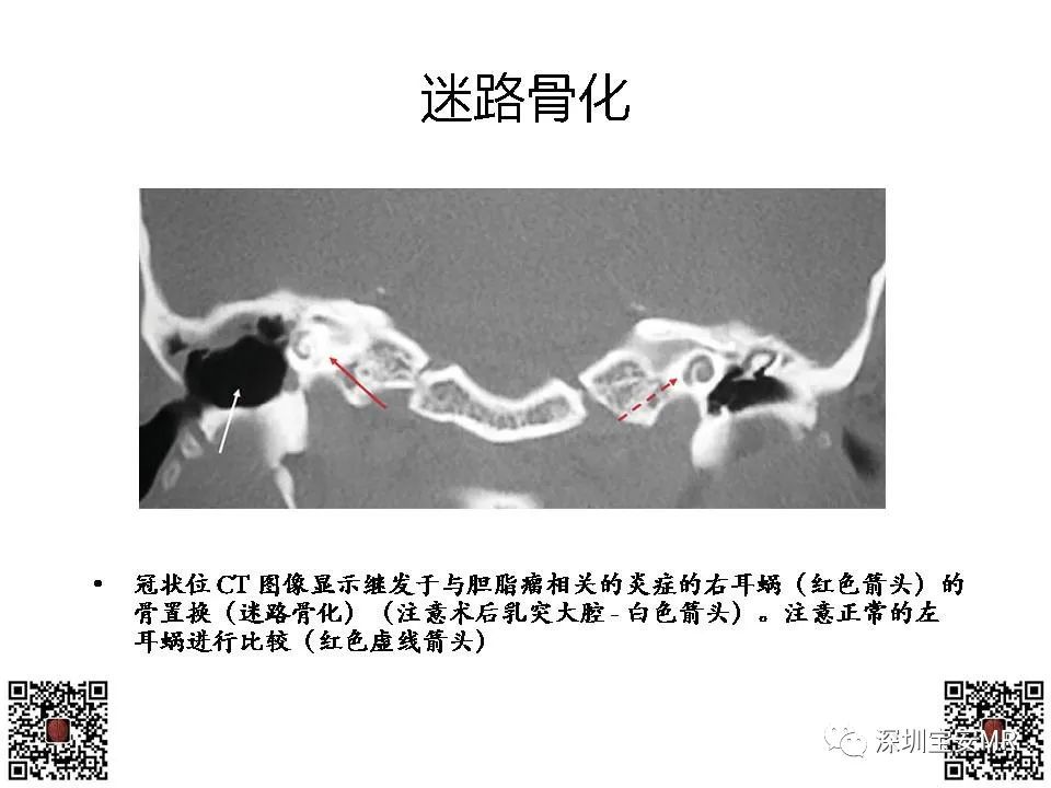 【PPT】感音性听力损失的影像检查-8