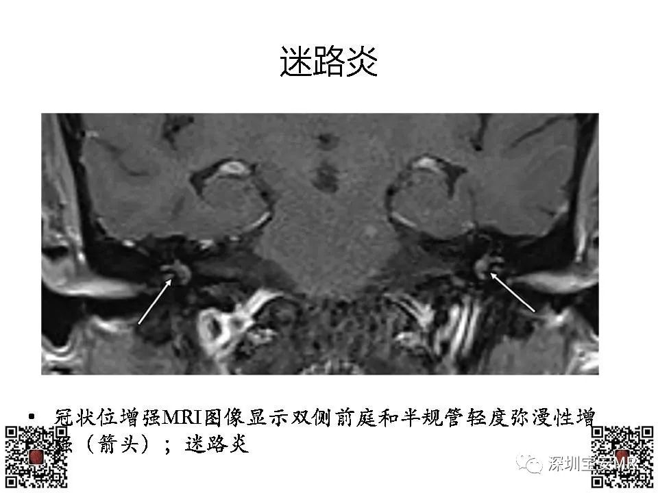 【PPT】感音性听力损失的影像检查-9