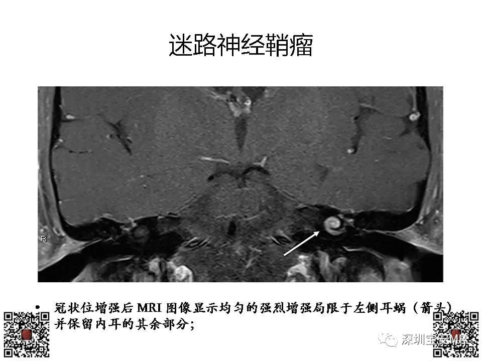 【PPT】感音性听力损失的影像检查-10