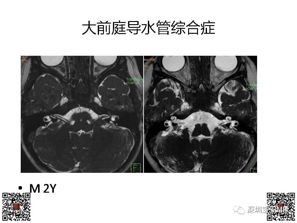 【PPT】感音性听力损失的影像检查-11