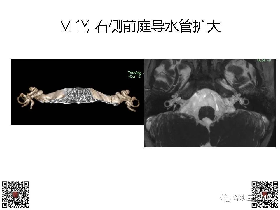 【PPT】感音性听力损失的影像检查-12
