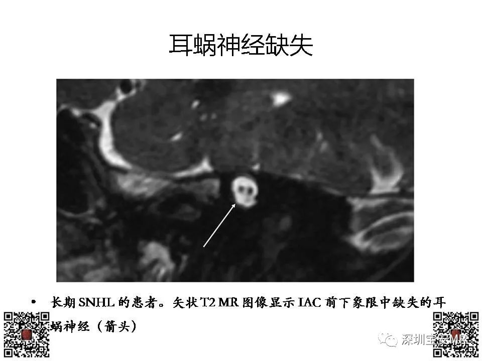 【PPT】感音性听力损失的影像检查-17