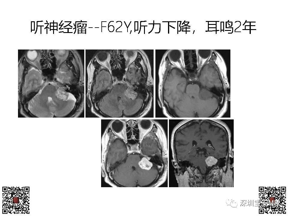 【PPT】感音性听力损失的影像检查-18