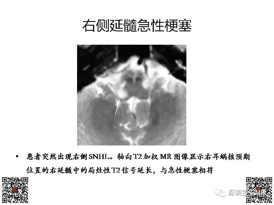 【PPT】感音性听力损失的影像检查-20