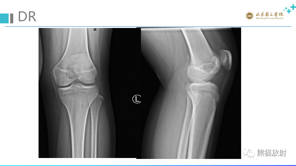 【病例】股骨远端动脉瘤样骨囊肿ABC VS 软骨母细胞瘤-7