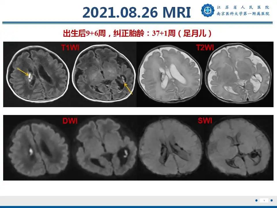 【PPT】生发基质-脑室内出血-4